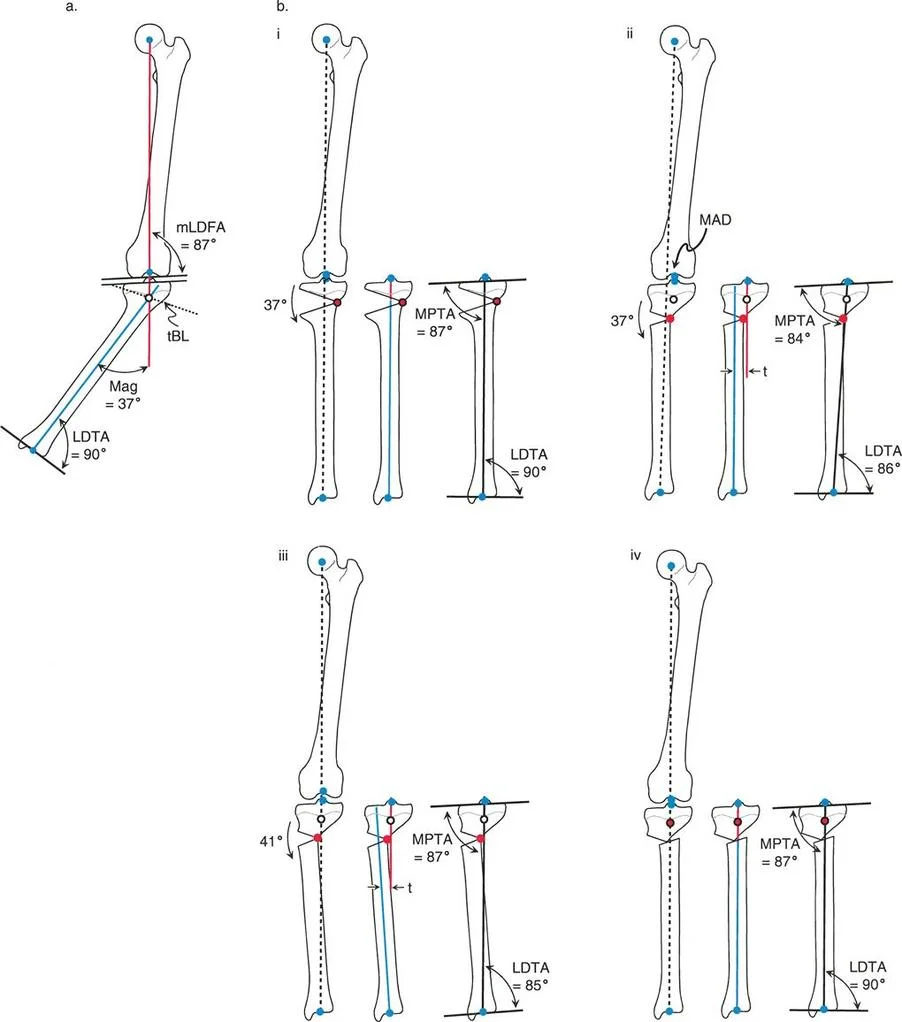 صورة توضيحية لـ إتقان قطع العظم القبة لتقويم تشوهات الأطراف: دليلك الشامل في صنعاء مع الأستاذ الدكتور محمد هطيف