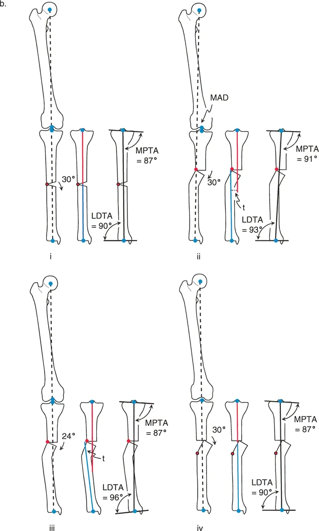 صورة توضيحية لـ إتقان قطع العظم القبة لتقويم تشوهات الأطراف: دليلك الشامل في صنعاء مع الأستاذ الدكتور محمد هطيف