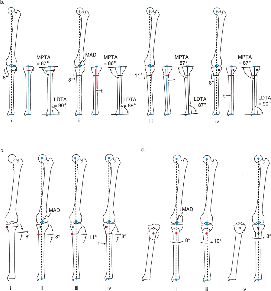 صورة توضيحية لـ إتقان قطع العظم القبة لتقويم تشوهات الأطراف: دليلك الشامل في صنعاء مع الأستاذ الدكتور محمد هطيف