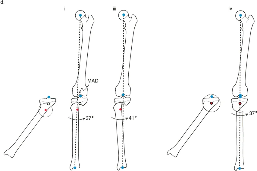 صورة طبية: إتقان قطع العظم القبة لتقويم تشوهات الأطراف: دليلك الشامل في صنعاء مع الأستاذ الدكتور محمد هطيف