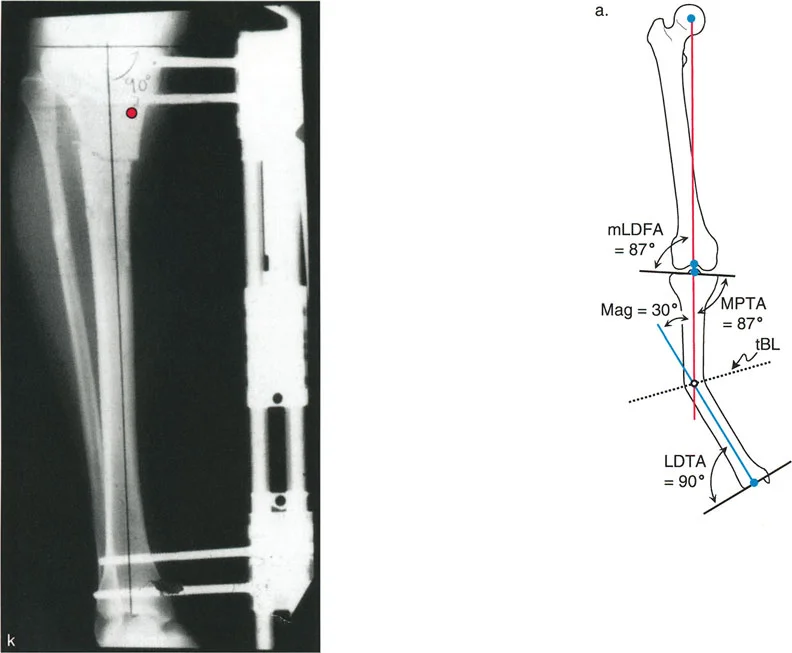 صورة توضيحية لـ إتقان قطع العظم القبة لتقويم تشوهات الأطراف: دليلك الشامل في صنعاء مع الأستاذ الدكتور محمد هطيف