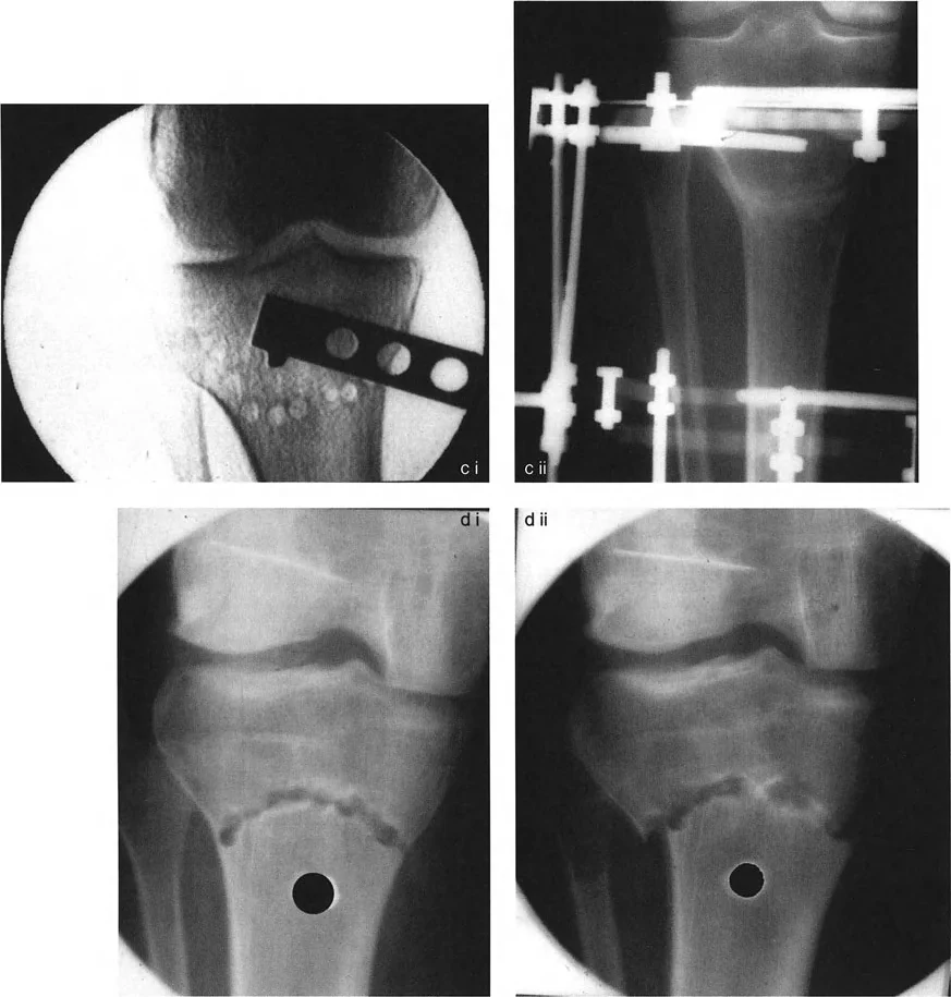 فشل محاذاة محور التصحيح مع مركز الدوران يؤدي إلى تشوه ثانوي