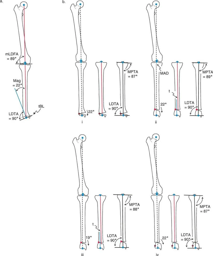 إتقان تصحيح استقامة الساقين: الدليل الشامل لمفاهيم بالي لقطع العظم في صنعاء