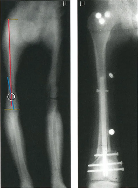 توضيح لقاعدة بالي 2: التصحيح الزاوي مع الانزياح، حيث يتم الحفاظ على المحور الميكانيكي المستقيم