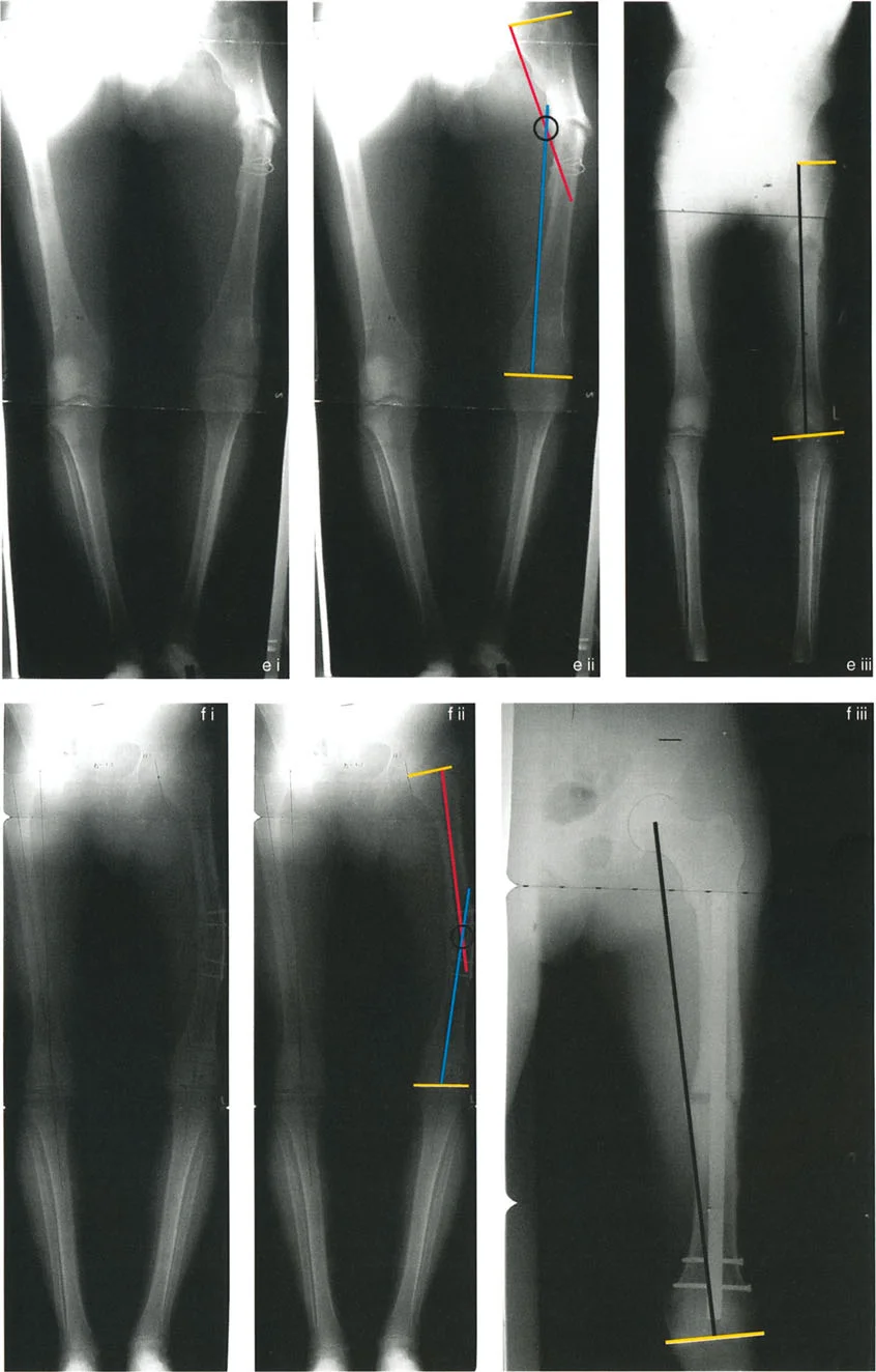 توضيح لمركز دوران الانحراف (CORA) والمحاور الميكانيكية في الطرف السفلي