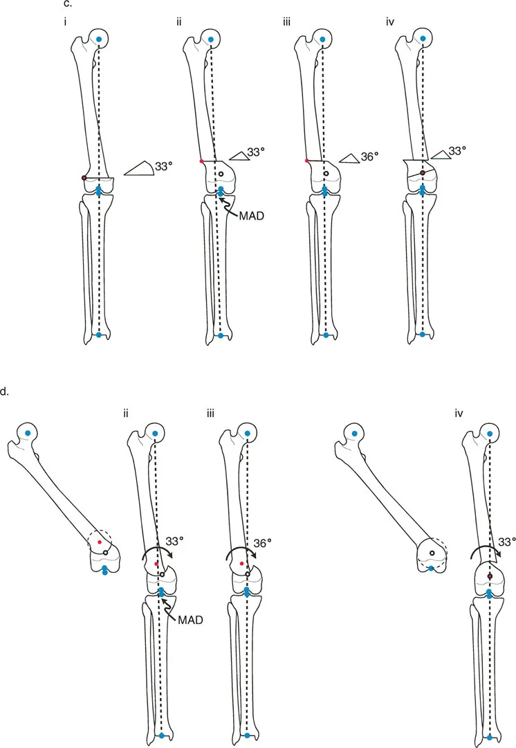 صورة توضيحية لـ تقويم تشوهات الأطراف السفلية الدقيق: مفاهيم الدكتور بالي وإعادة محاذاة المحور الأمامي مع الأستاذ الدكتور محمد هطيف في صنعاء