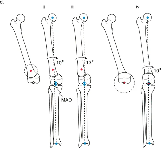 صورة توضيحية لـ تقويم تشوهات الأطراف السفلية الدقيق: مفاهيم الدكتور بالي وإعادة محاذاة المحور الأمامي مع الأستاذ الدكتور محمد هطيف في صنعاء
