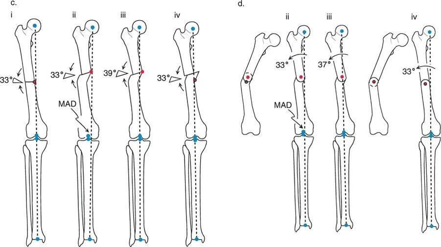 صورة توضيحية لـ تقويم تشوهات الأطراف السفلية الدقيق: مفاهيم الدكتور بالي وإعادة محاذاة المحور الأمامي مع الأستاذ الدكتور محمد هطيف في صنعاء