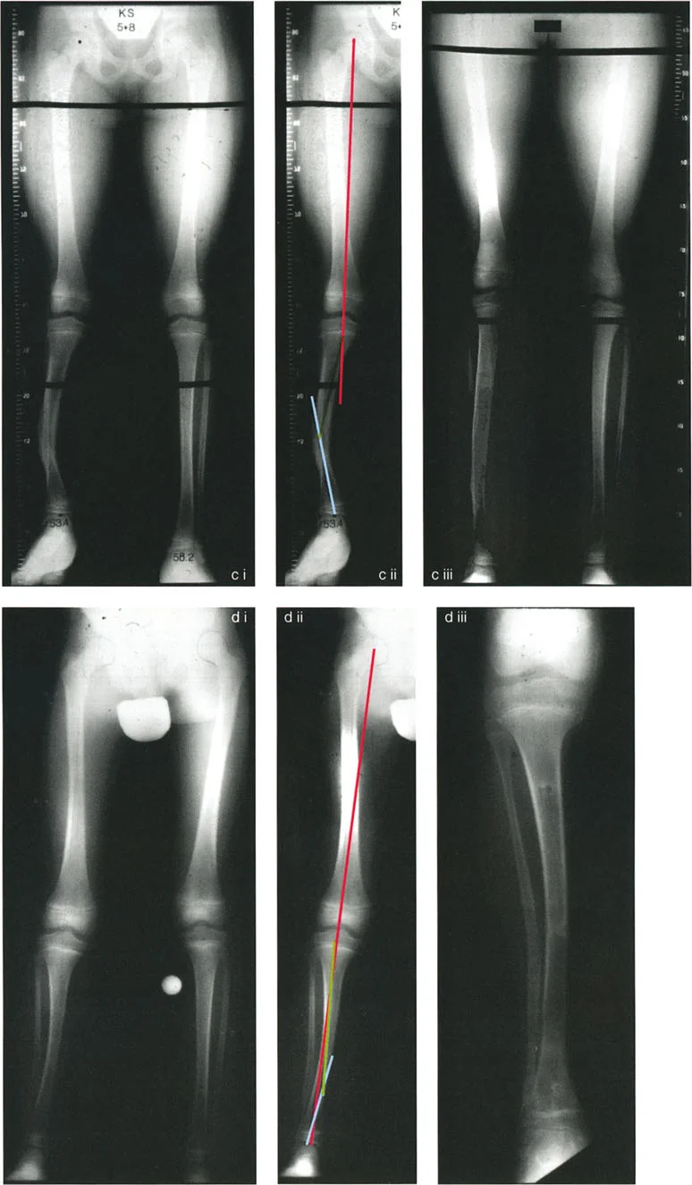 صورة طبية: تقويم تشوهات الأطراف السفلية بدقة متناهية: دليلك الشامل لمبادئ بالي المتقدمة ومركز دوران الانحراف (CORA)