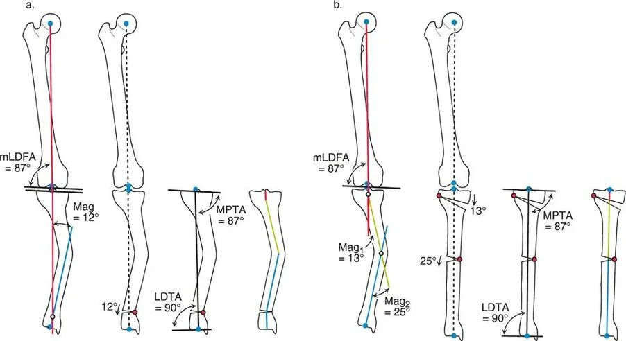 صورة طبية: تقويم تشوهات الأطراف السفلية بدقة متناهية: دليلك الشامل لمبادئ بالي المتقدمة ومركز دوران الانحراف (CORA)