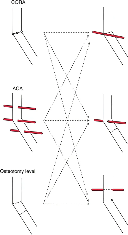 صورة بالأشعة السينية توضح خطوط المحور الميكانيكي وتحديد مركز دوران الانحراف (CORA) في عظم مشوه.