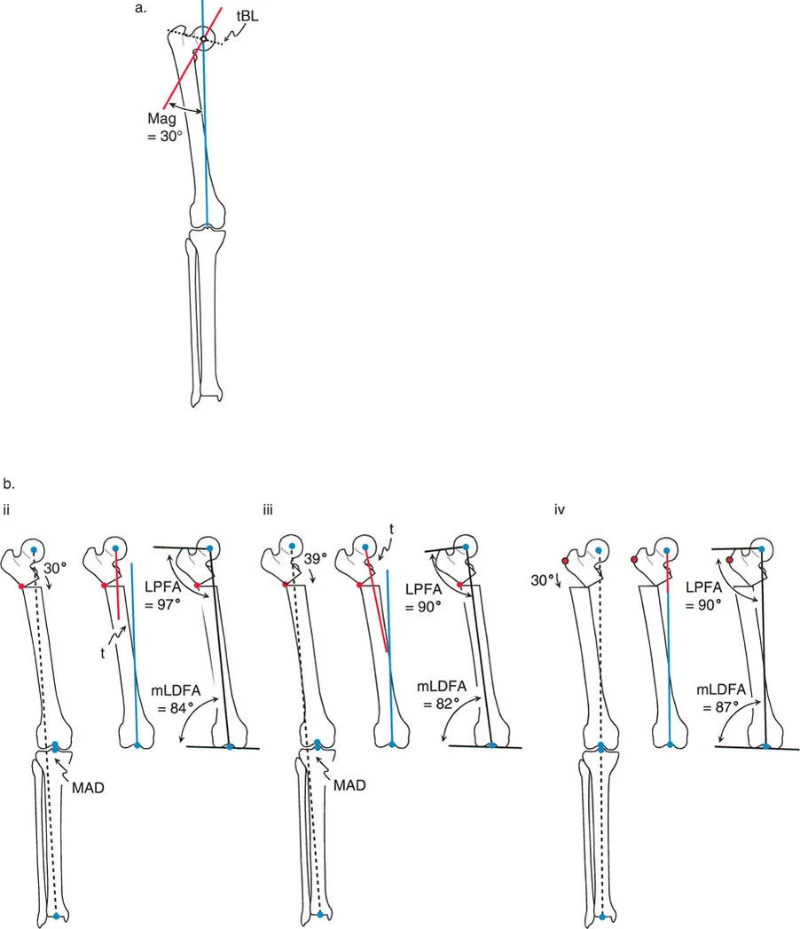 صورة توضيحية لـ تقويم تشوهات الأطراف السفلية بدقة متناهية: دليلك الشامل لمبادئ بالي المتقدمة ومركز دوران الانحراف (CORA)