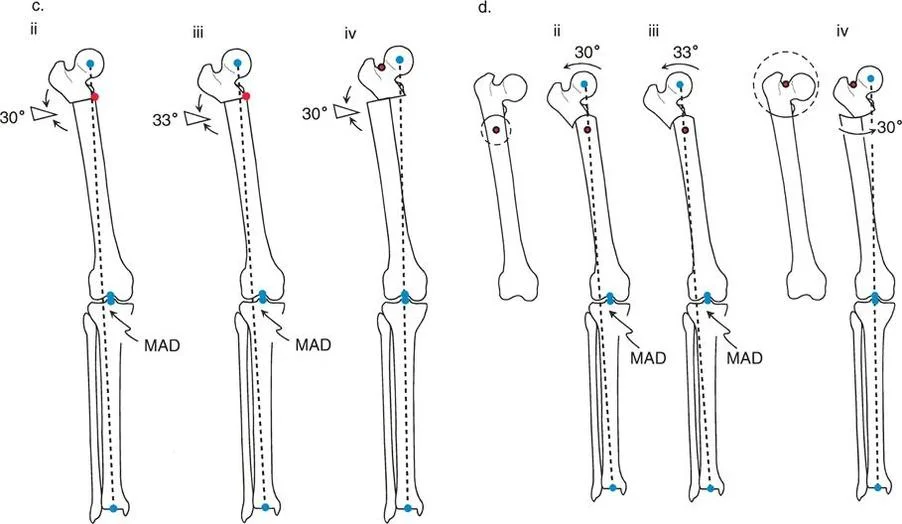 صورة توضيحية لـ تقويم تشوهات الأطراف السفلية بدقة متناهية: دليلك الشامل لمبادئ بالي المتقدمة ومركز دوران الانحراف (CORA)