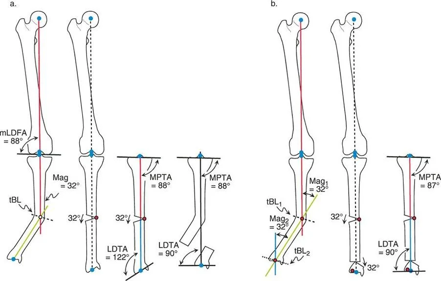 تصحيح انحرافات الساقين المعقدة: دليل شامل لتقويم تشوهات العظام متعددة المستويات في صنعاء