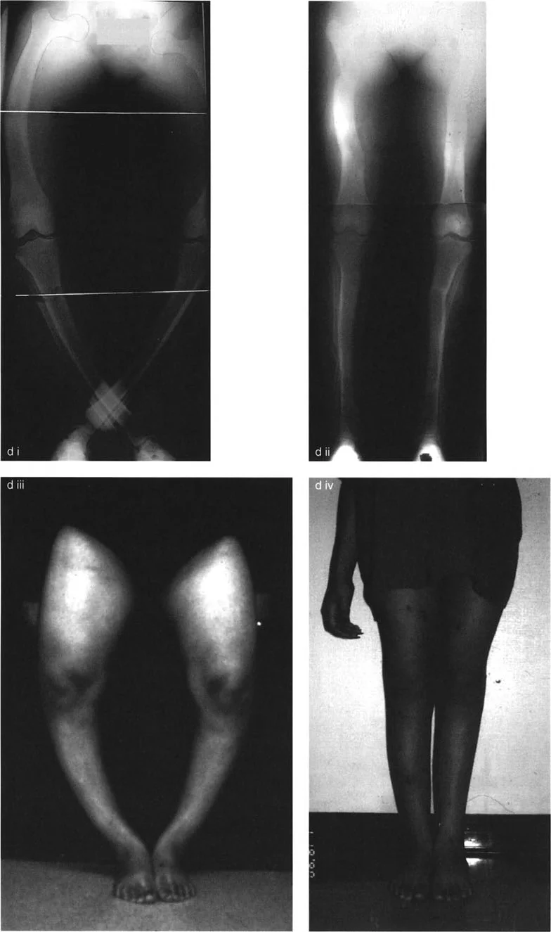 صورة توضيحية لـ جراحة تقويم انحرافات العظام في المستوى الأمامي: حلول متقدمة لتشوهات الأطراف السفلية المعقدة