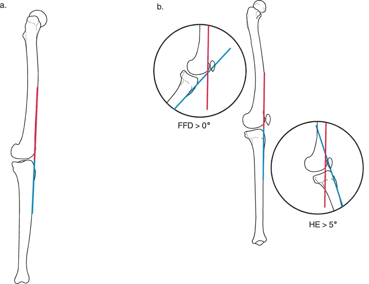 صورة توضيحية لـ الأستاذ الدكتور محمد هطيف: دليل شامل لتشوهات الركبة السهمية (التقوس الأمامي والخلفي) في صنعاء
