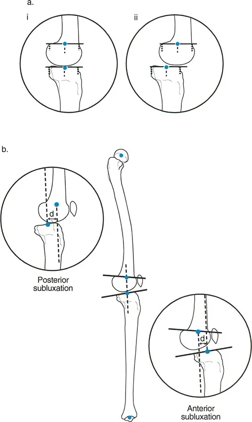صورة توضيحية لـ الأستاذ الدكتور محمد هطيف: دليل شامل لتشوهات الركبة السهمية (التقوس الأمامي والخلفي) في صنعاء