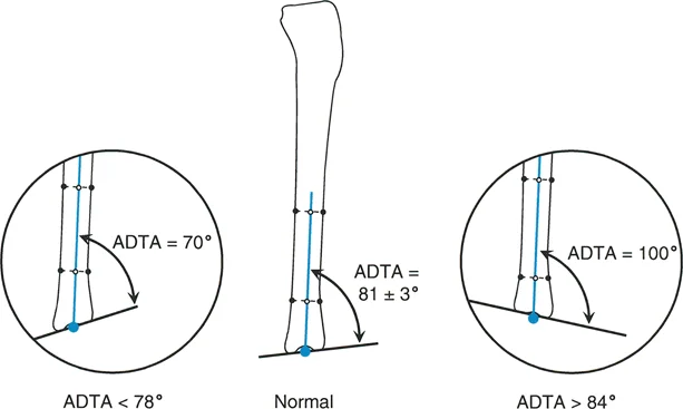 صورة طبية: الأستاذ الدكتور محمد هطيف: دليل شامل لتشوهات الركبة السهمية (التقوس الأمامي والخلفي) في صنعاء