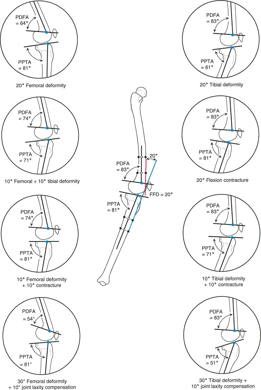 صورة طبية: الأستاذ الدكتور محمد هطيف: دليل شامل لتشوهات الركبة السهمية (التقوس الأمامي والخلفي) في صنعاء