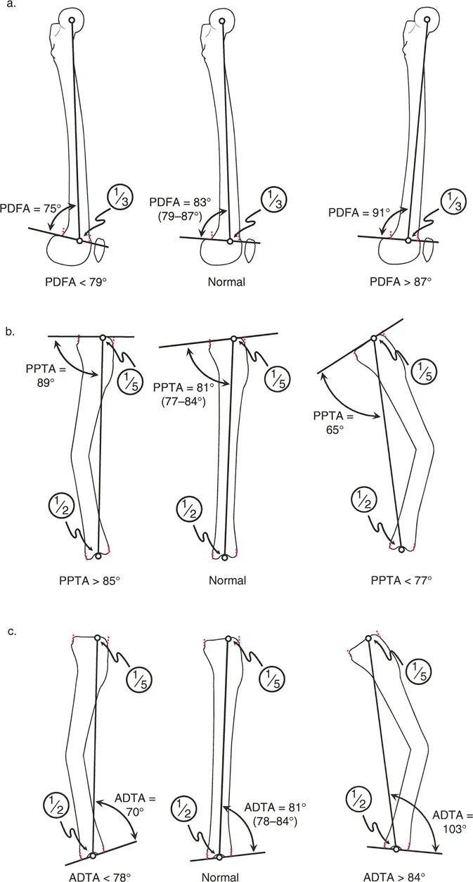 صورة طبية: الأستاذ الدكتور محمد هطيف: دليل شامل لتشوهات الركبة السهمية (التقوس الأمامي والخلفي) في صنعاء