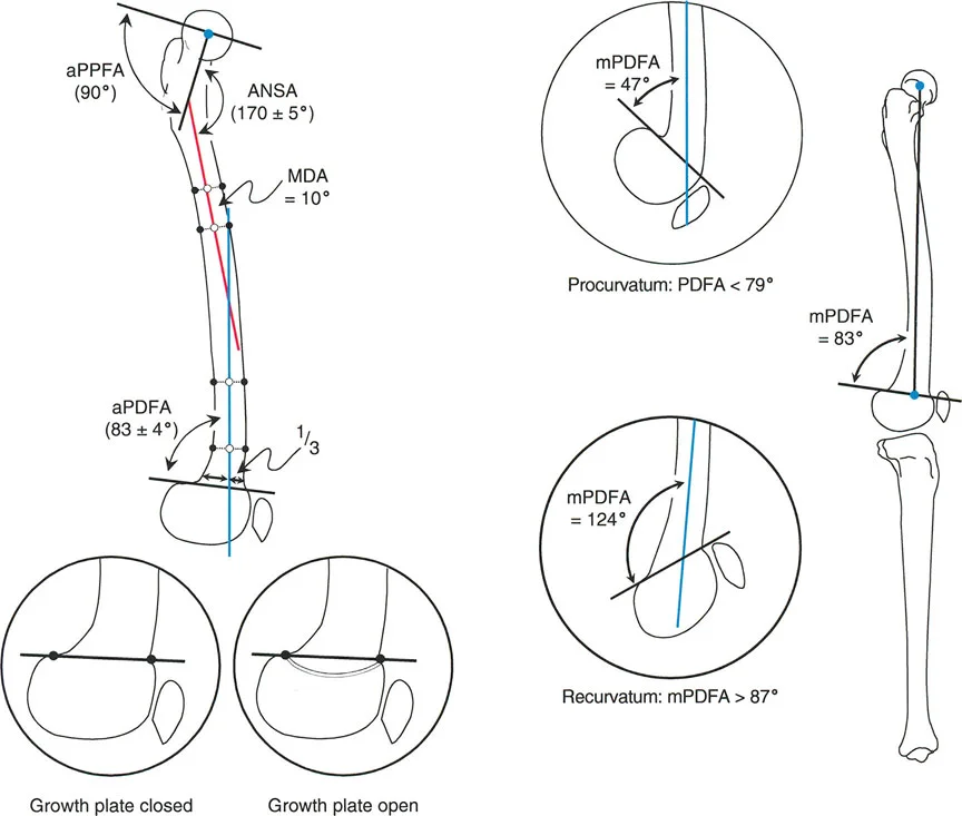 صورة طبية: الأستاذ الدكتور محمد هطيف: دليل شامل لتشوهات الركبة السهمية (التقوس الأمامي والخلفي) في صنعاء