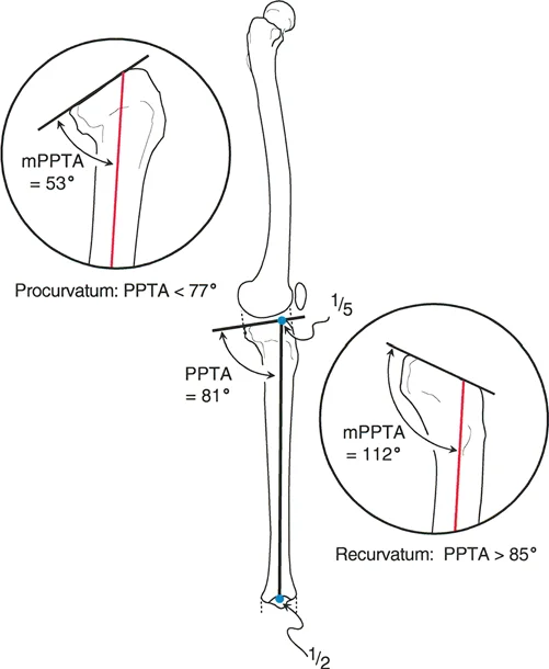 صورة طبية: الأستاذ الدكتور محمد هطيف: دليل شامل لتشوهات الركبة السهمية (التقوس الأمامي والخلفي) في صنعاء