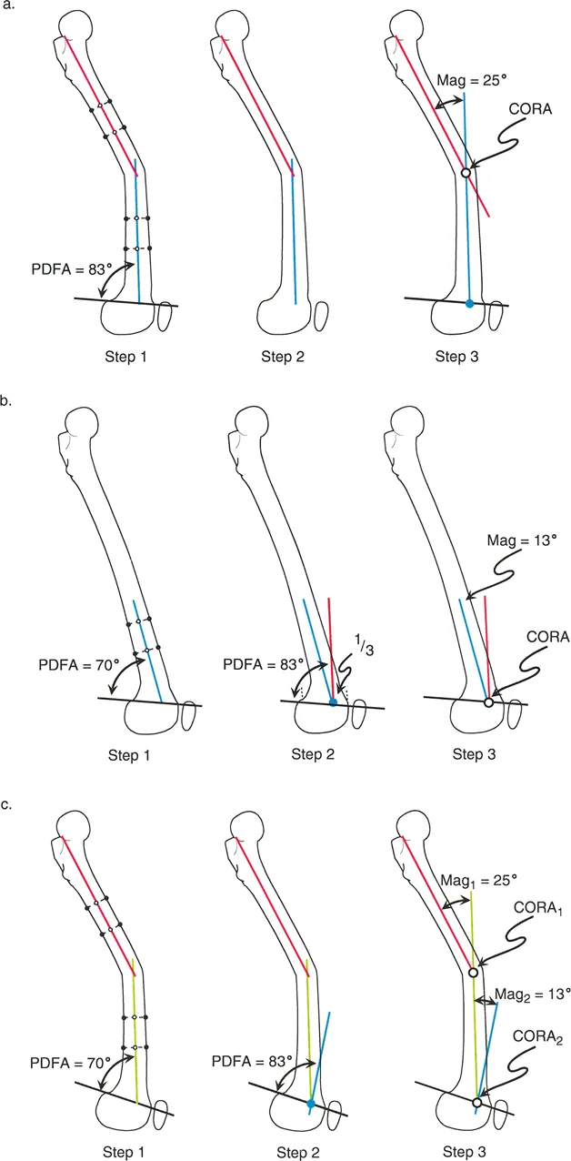 التخطيط المحوري التشريحي لتصحيح تشوه الفخذ في المستوى السهمي. (أ) تشوه منتصف الفخذ. (ب) تشوه الفخذ البعيد. (ج) مزيج من تشوه منتصف الفخذ والبعيد.