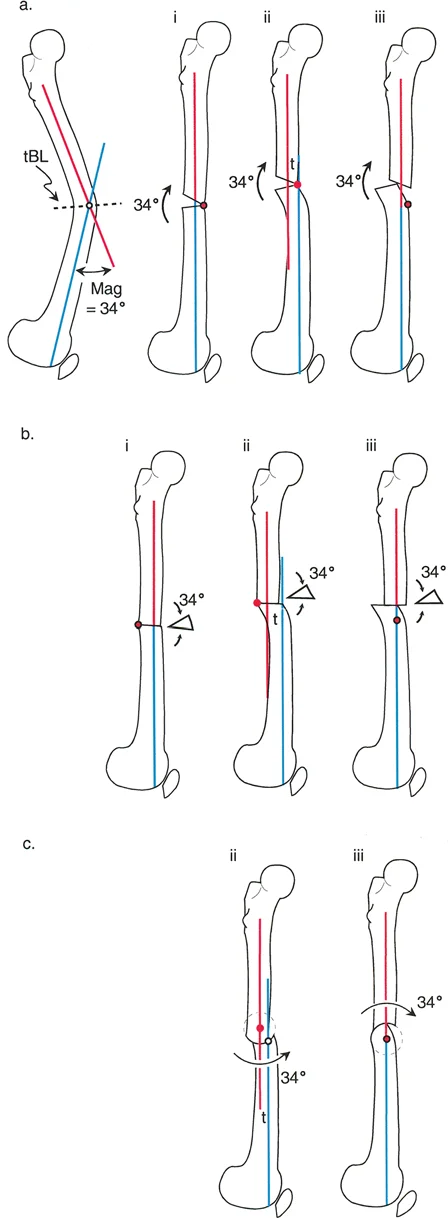 صورة توضيحية لـ تشوهات المستوى السهمي للطرف السفلي: دليلك الشامل لطريقة بالي مع الأستاذ الدكتور محمد هطيف في صنعاء