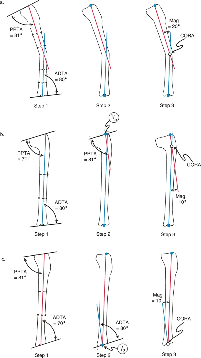 التخطيط المحوري التشريحي لتشوه الساق في المستوى السهمي. (أ) تشوه منتصف الساق. (ب) تشوه الساق القريب. (ج) تشوه الساق البعيد.
