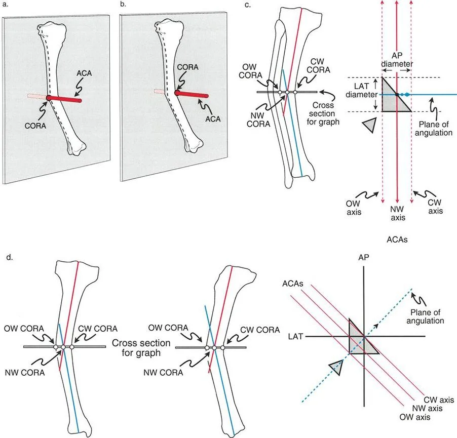 صورة توضيحية لأنواع قطع العظم لتصحيح التشوهات