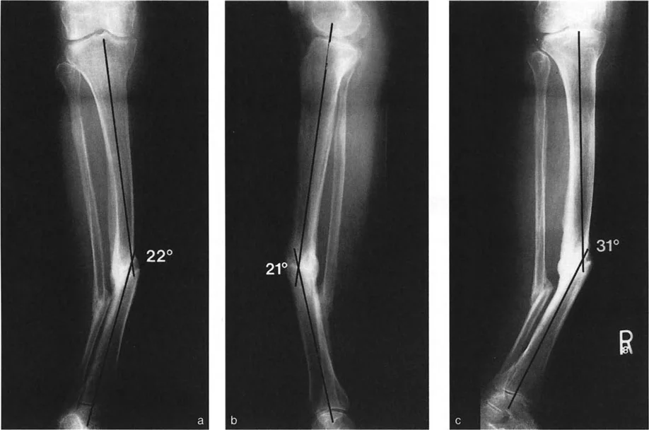 تشوهات المستوى المائل: دليلك الشامل لتصحيح انحرافات العظام المعقدة مع الأستاذ الدكتور محمد هطيف في صنعاء