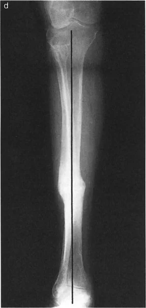 صورة توضيحية ل عظم يبدو مستقيمًا عند النظر إليه من زاوية معينة
