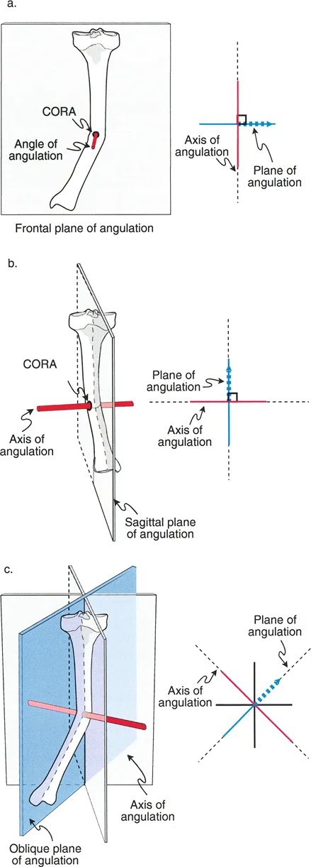 صورة توضيحية لمحور الانحراف في تشوه المستوى المائل