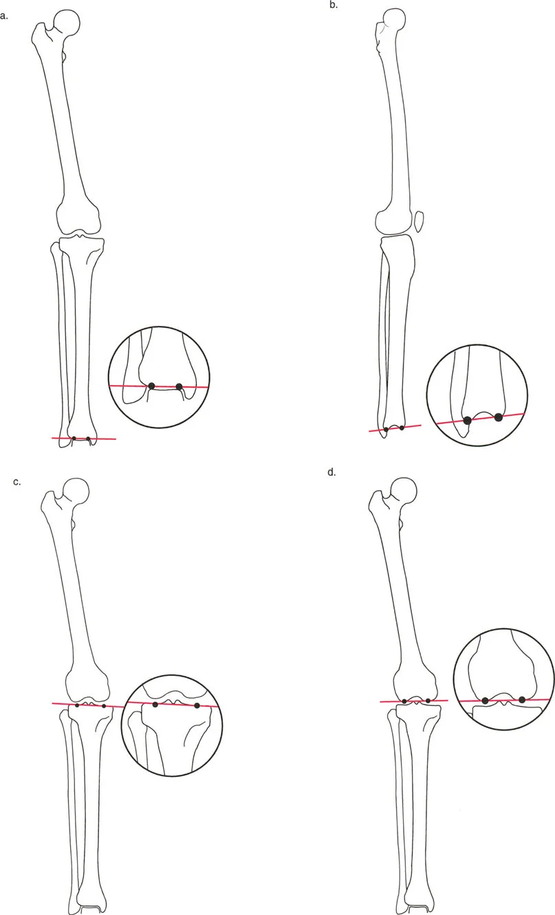 فهم شامل لمحاذاة الأطراف السفلية وتوجيه المفاصل: مبادئ بالي وخبرة الأستاذ الدكتور محمد هطيف