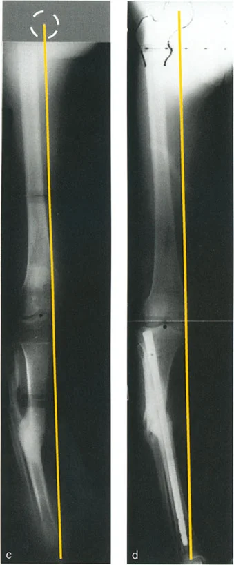 صورة توضيحية لـ تشوهات الانحراف والانزياح العظمي: دليل شامل لفهم وعلاج انحرافات العظام المعقدة مع الأستاذ الدكتور محمد هطيف