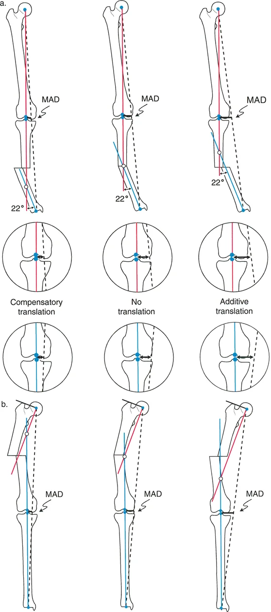 تشوهات الانحراف والانزياح العظمي: دليل شامل لفهم وعلاج انحرافات العظام المعقدة مع الأستاذ الدكتور محمد هطيف
