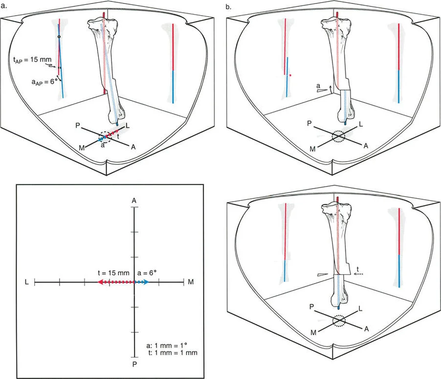 رسم توضيحي لمركز الدوران الزاوي للانحراف والإزاحة (a-t CORA) وكيفية تقاطع المحاور التشريحية للجزء القريب والبعيد من العظم عند هذه النقطة، مما يوضح الفرق بين الانحراف الزاوي البحت والانحراف مع الإزاحة.