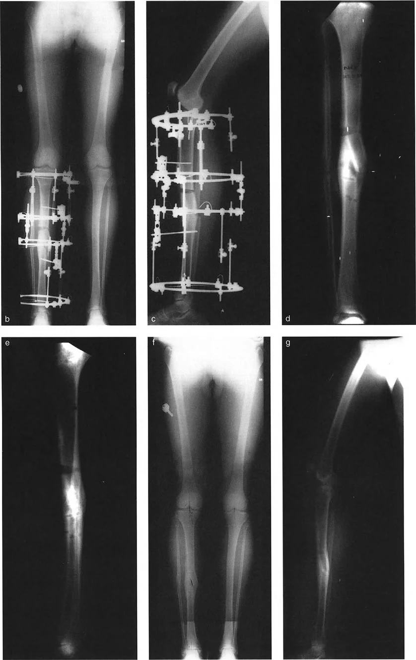 صورة توضيحية لـ تصحيح تشوهات الانحراف والإزاحة العظمية: دليل شامل للمرضى مع الأستاذ الدكتور محمد هطيف