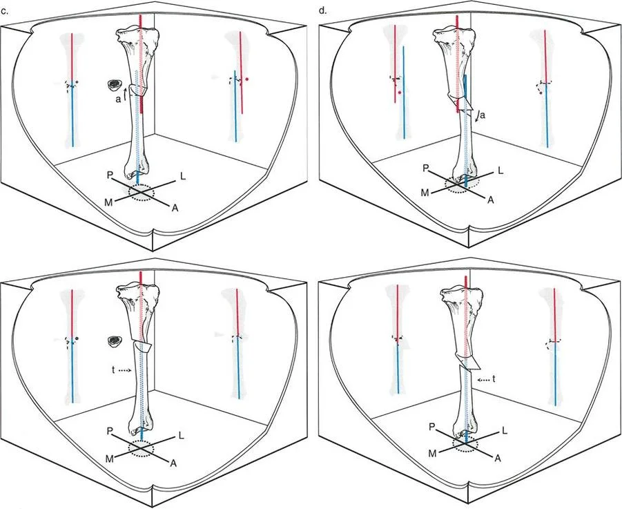 صورة توضيحية لـ تصحيح تشوهات الانحراف والإزاحة العظمية: دليل شامل للمرضى مع الأستاذ الدكتور محمد هطيف