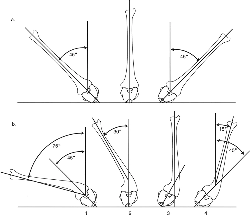 التأثير العميق لتشوه عظم الساق على تقييم دوران الورك. (أ) عظم الساق الطبيعي: الساق العمودية تمثل الصفر الحقيقي. (ب) عظم الساق مع تقوس 30 درجة: الاعتماد على جسم عظم الساق يؤدي إلى قراءات خاطئة (الجزء 4 مقابل الجزء 1). يجب تحديد الصفر الحقيقي عن طريق تسوية لقمتي الفخذ وتوجيه الرضفة مباشرة إلى الأسفل (الجزء 2).