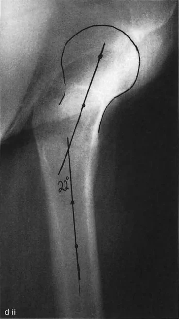 التقييم الإشعاعي للجزء القريب من عظم الفخذ. يتم قياس الزاوية بين محور عنق الفخذ ومحور جسم العظم على أفلام متعامدة موحدة لحساب الدوران الحقيقي عبر تحليل المستوى المائل.