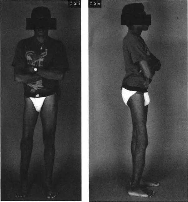 صورة طبية: تشوهات الدوران والانحراف الزاوي في العظام: دليل المريض الشامل من الأستاذ الدكتور محمد هطيف