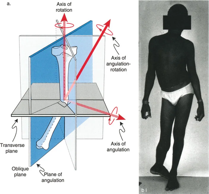 صورة طبية: تشوهات الدوران والانحراف الزاوي في العظام: دليل المريض الشامل من الأستاذ الدكتور محمد هطيف