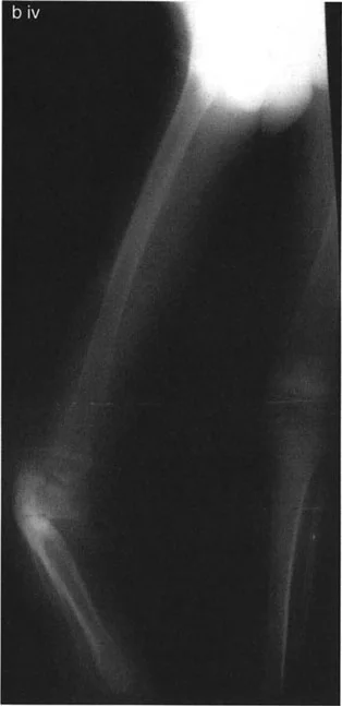 صورة طبية: تشوهات الدوران والانحراف الزاوي في العظام: دليل المريض الشامل من الأستاذ الدكتور محمد هطيف