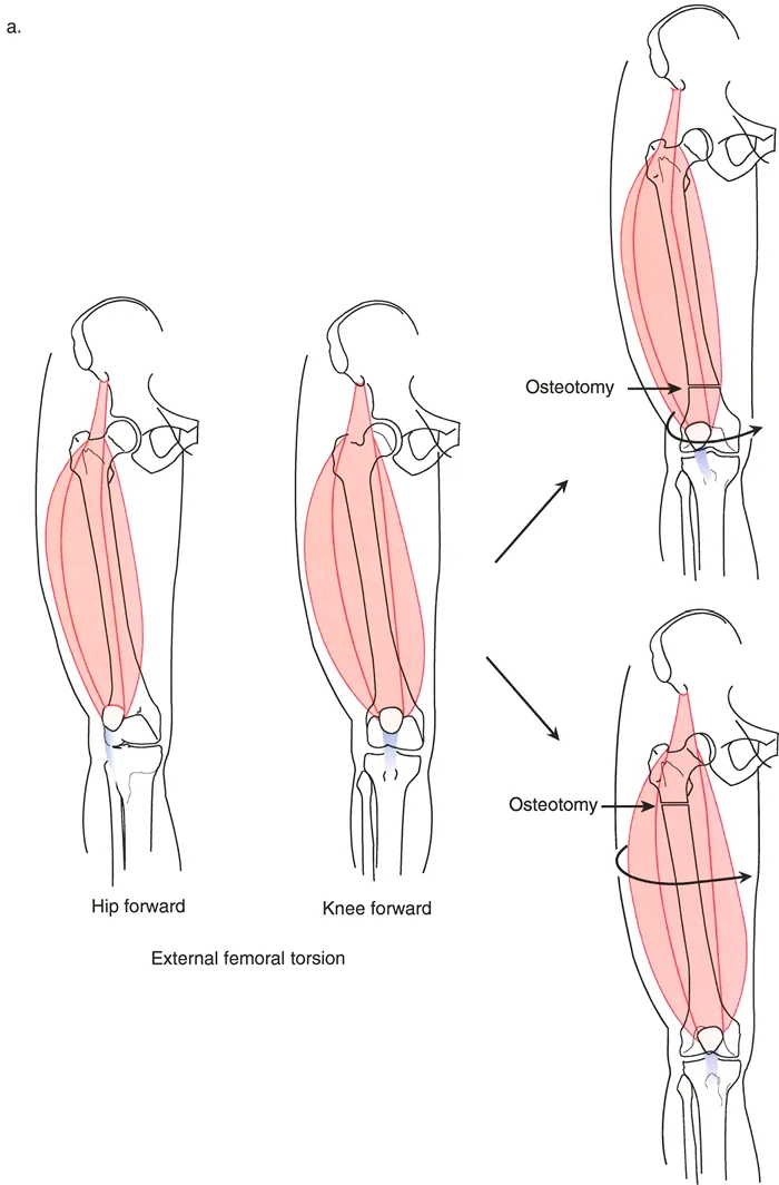 صورة طبية: تشوهات الدوران والانحراف الزاوي في العظام: دليل المريض الشامل من الأستاذ الدكتور محمد هطيف