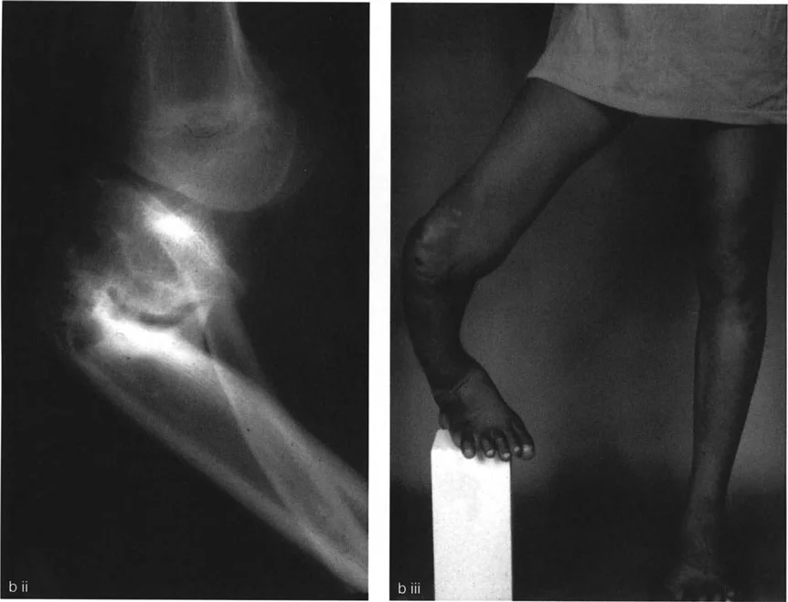 صورة طبية: تشوهات الدوران والانحراف الزاوي في العظام: دليل المريض الشامل من الأستاذ الدكتور محمد هطيف