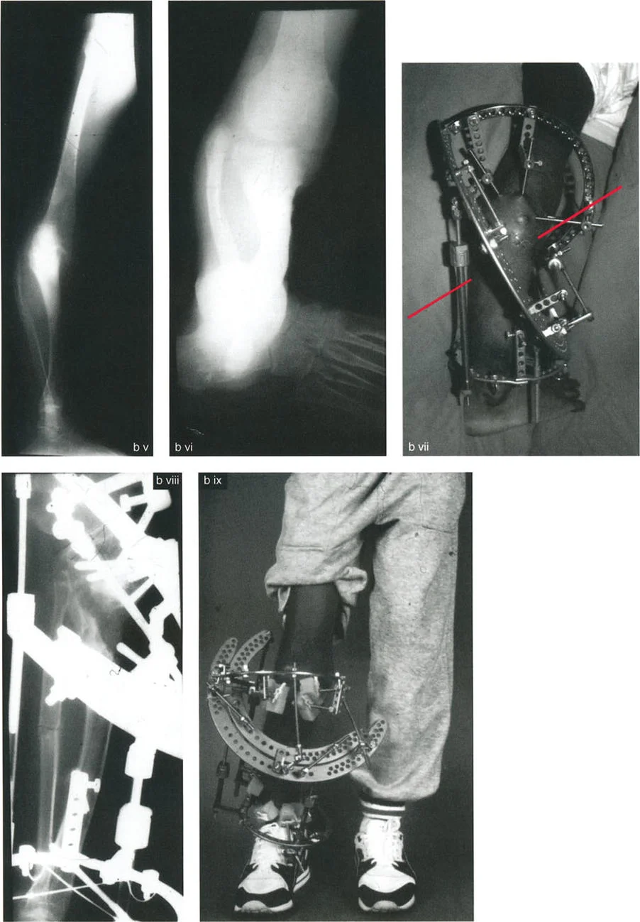 صورة طبية: تشوهات الدوران والانحراف الزاوي في العظام: دليل المريض الشامل من الأستاذ الدكتور محمد هطيف