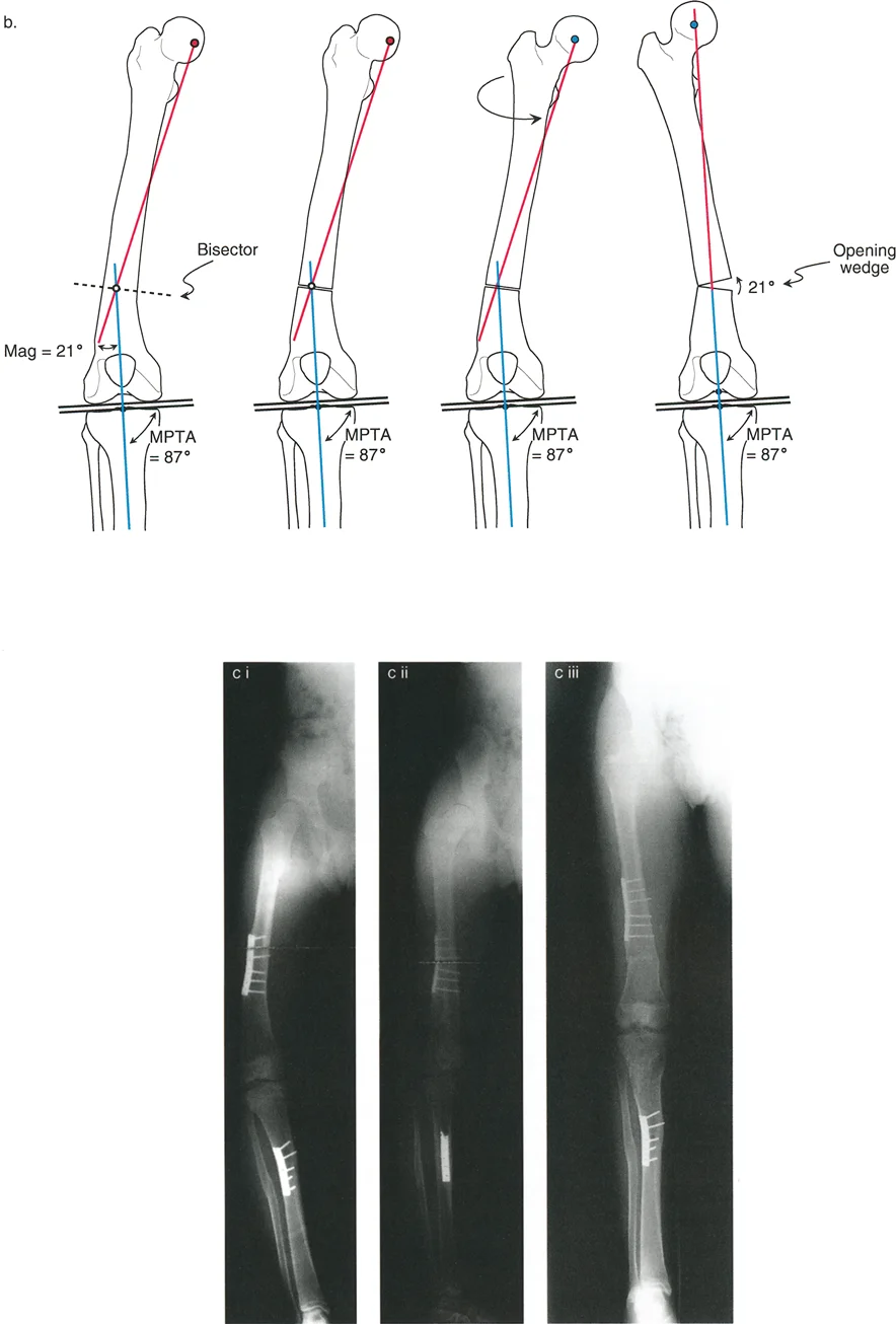 صورة طبية: تشوهات الدوران والانحراف الزاوي في العظام: دليل المريض الشامل من الأستاذ الدكتور محمد هطيف