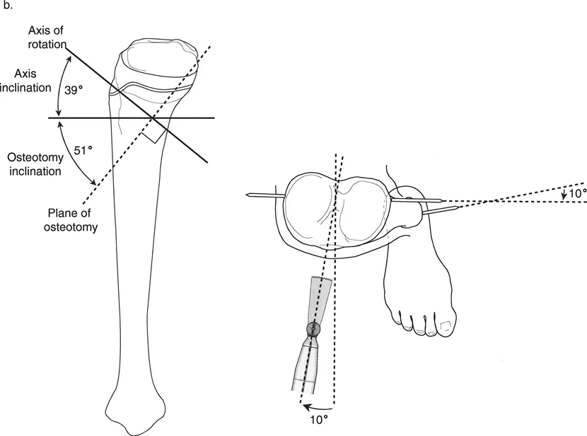 صورة توضيحية لـ تقنية بالي لقطع العظم المائل: الحل الجراحي المتقدم لتشوهات الأطراف المعقدة في صنعاء