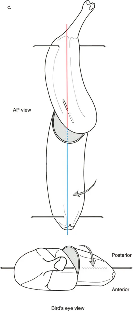 صورة توضيحية لـ تقنية بالي لقطع العظم المائل: الحل الجراحي المتقدم لتشوهات الأطراف المعقدة في صنعاء